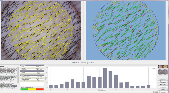 德国TrichoScan毛发分析系统